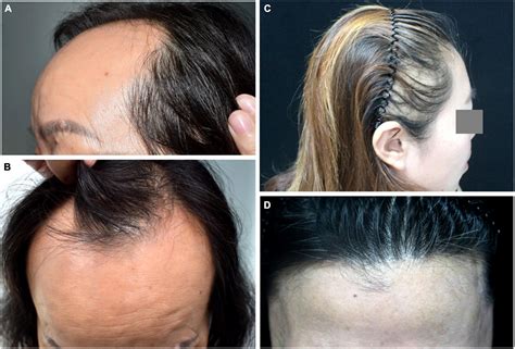 It&39;s a form of lichen planopilaris. . Frontal fibrosing alopecia treatment 2021